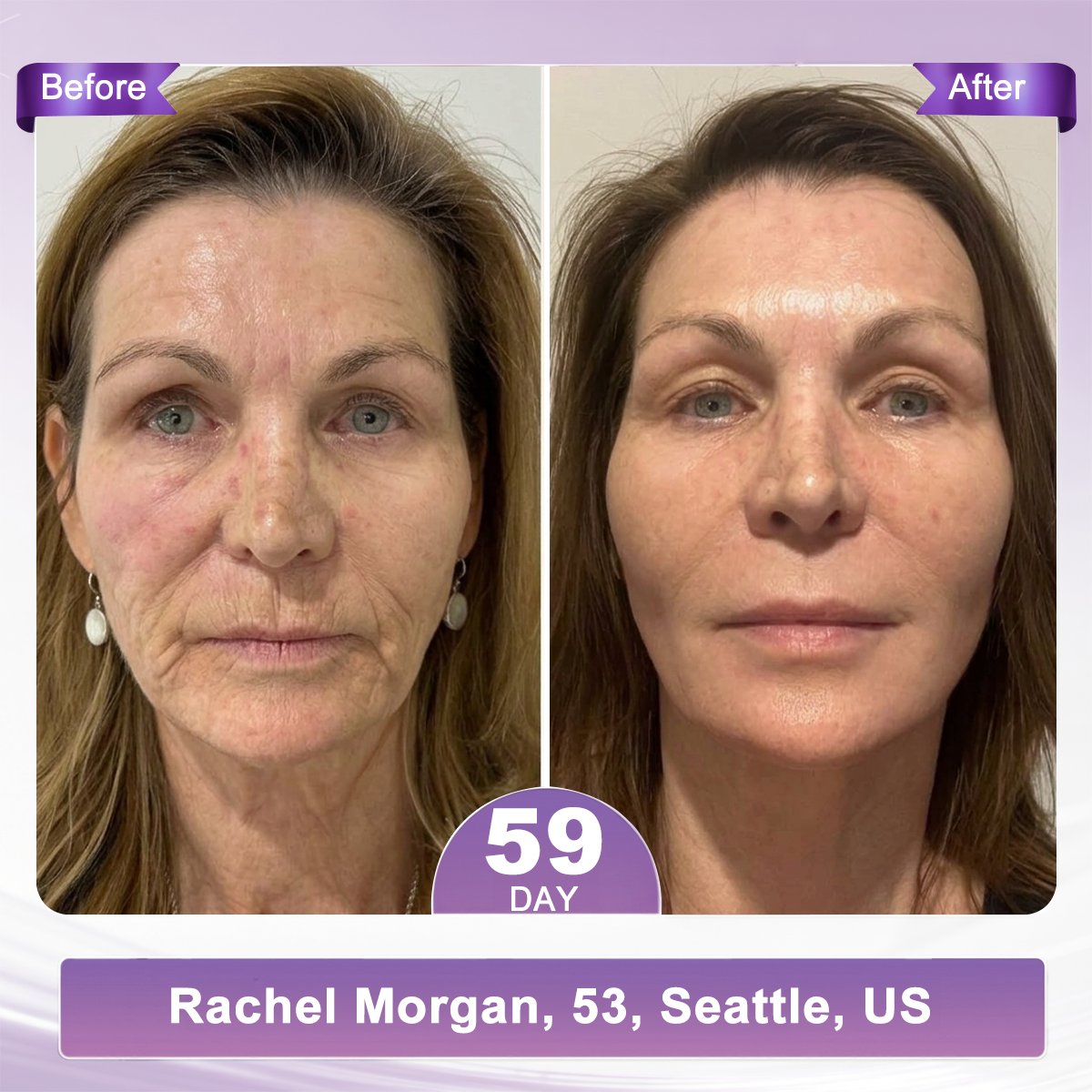 𝐇𝐈𝐒𝐊𝐈𝐍® 𝐏𝐃𝐑𝐍 𝐌𝐮𝐥𝐭𝐢-𝐏𝐞𝐩𝐭𝐢𝐝𝐞 𝐌𝐚𝐬𝐬𝐚𝐠𝐢𝐧𝐠 𝐁𝐨𝐝𝐲 𝐑𝐨𝐥𝐥𝐞𝐫 𝐂𝐫𝐞𝐚𝐦- Anti-aging, Hydrating, Skin Firming & Lifting, Skin Repair, Even Tone, Acne and Dark Spot Treatment, Wart and Mole Removal, and Psoriasis Relief.