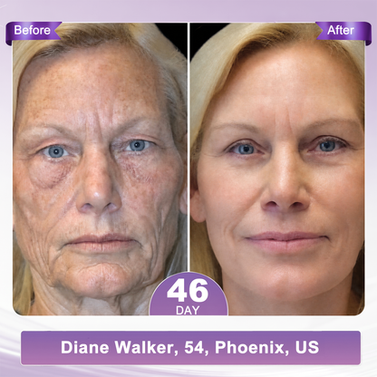 𝐇𝐈𝐒𝐊𝐈𝐍® 𝐏𝐃𝐑𝐍 𝐌𝐮𝐥𝐭𝐢-𝐏𝐞𝐩𝐭𝐢𝐝𝐞 𝐌𝐚𝐬𝐬𝐚𝐠𝐢𝐧𝐠 𝐁𝐨𝐝𝐲 𝐑𝐨𝐥𝐥𝐞𝐫 𝐂𝐫𝐞𝐚𝐦- Anti-aging, Hydrating, Skin Firming & Lifting, Skin Repair, Even Tone, Acne and Dark Spot Treatment, Wart and Mole Removal, and Psoriasis Relief.